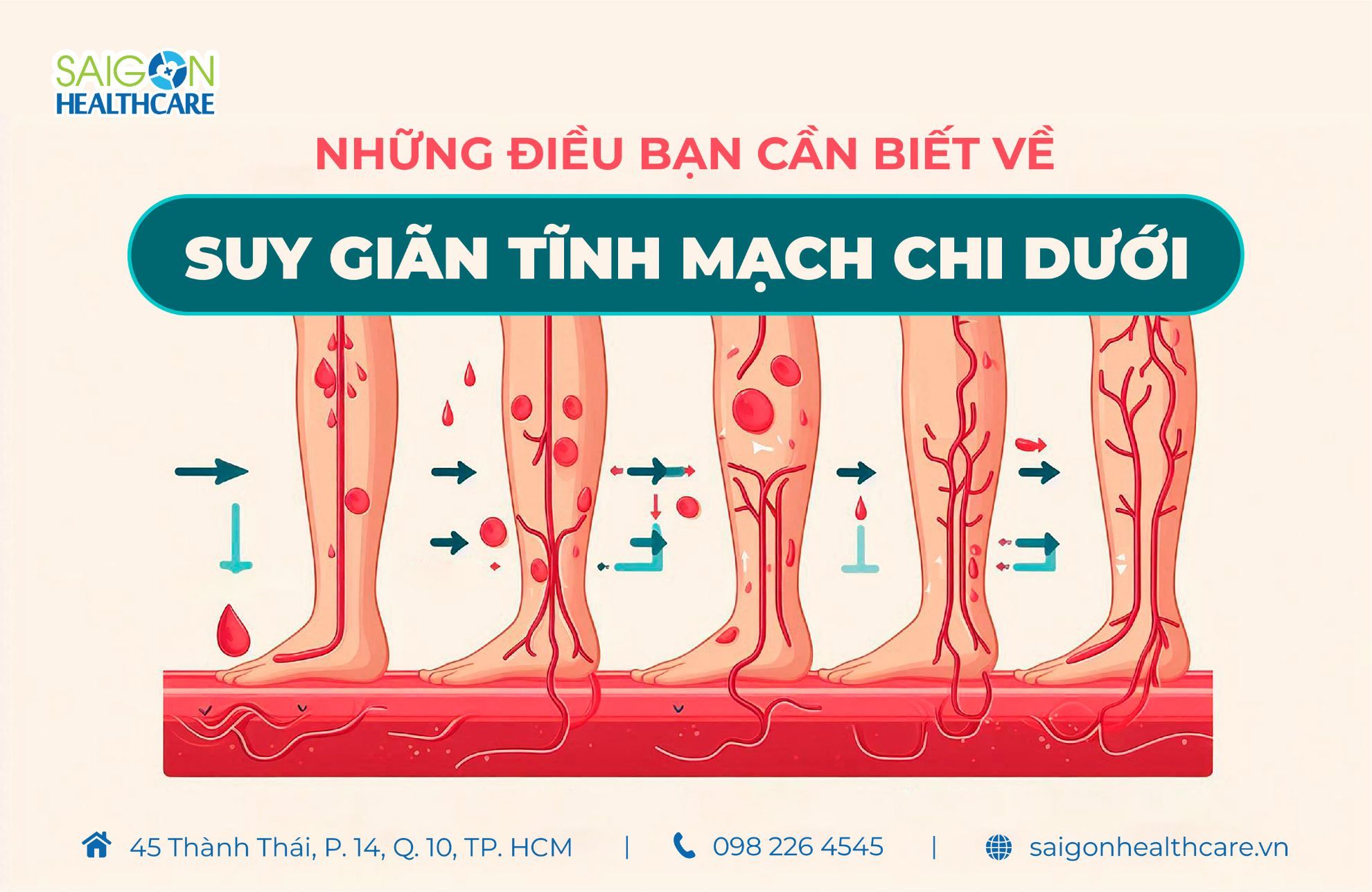 Những điều bạn cần biết về suy giãn tĩnh mạch chi dưới